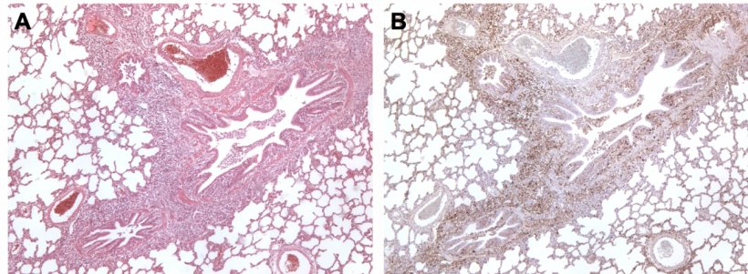 Ryc 3. Koinfekcja M. hyopneumoniae i PCV2 w płucach świń. A: Obszar okołoskrzelowej hiperplazji limfatycznej spowodowanej przez M. hyopneumoniae. B: Duża ilość antygenu PCV2 w tym samym obszarze rozrostu limfoidalnego.
